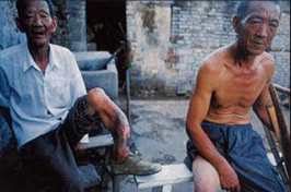 3毛衰成和截肢的弟弟，江山市上余镇王程村，兄弟俩于1942年6月感染炭疽烂腿.png